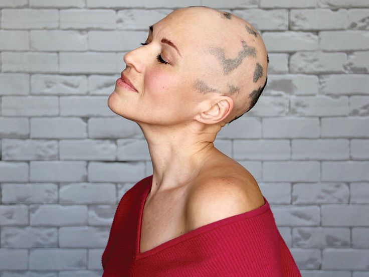 Woman with patchy hair loss from alopecia areata